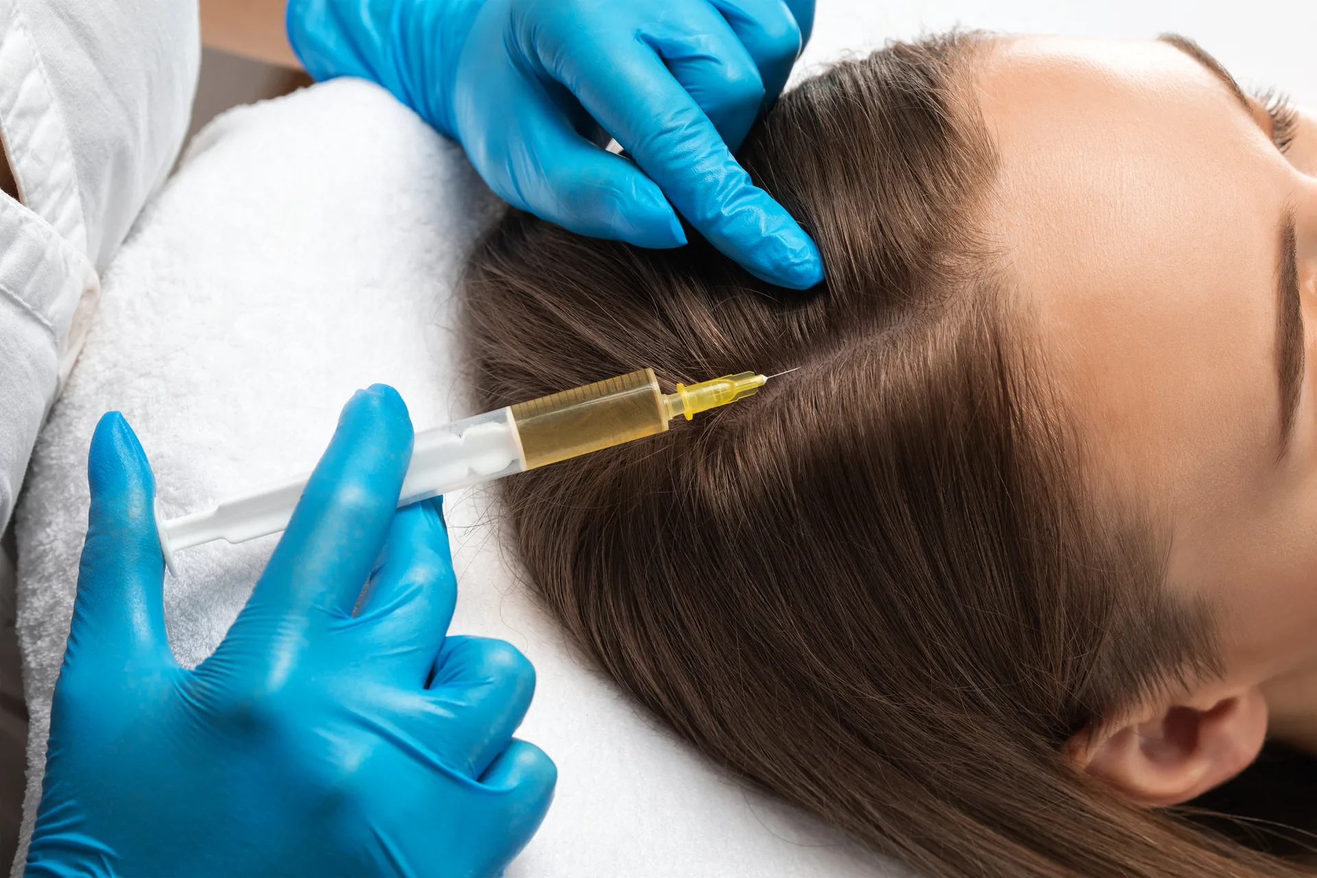PRF Hair Restoration at Younger You Aesthetics — Northern California