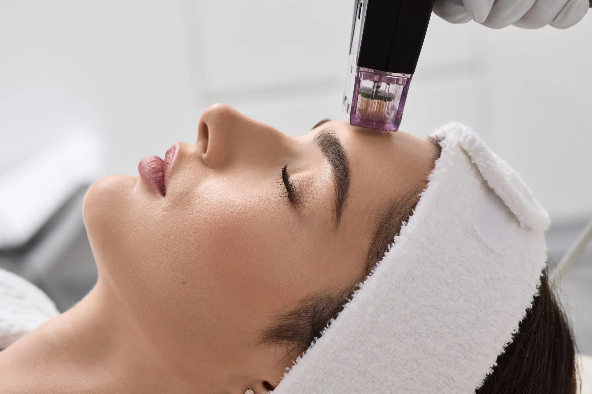 Sylfirm RF Microneedling at Younger You Aesthetics — Northern California